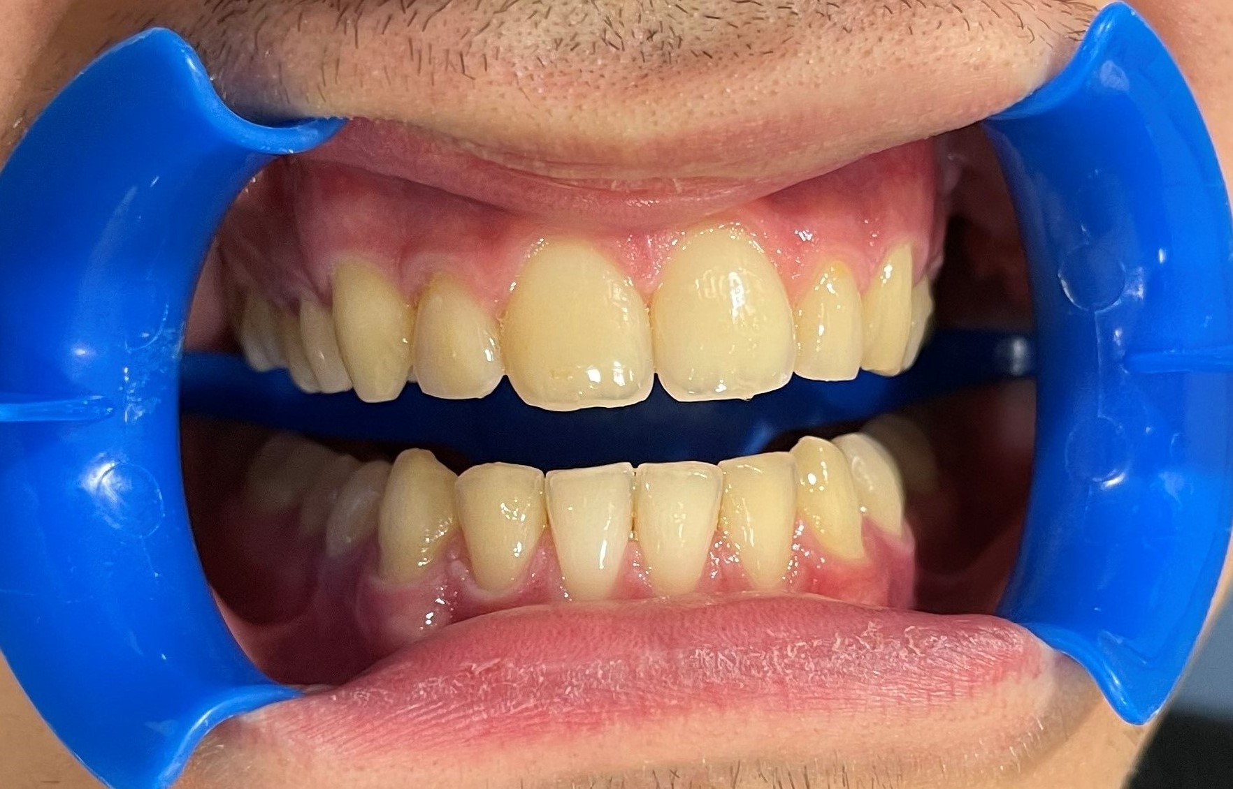 dientes amarillos sin blanqueamiento