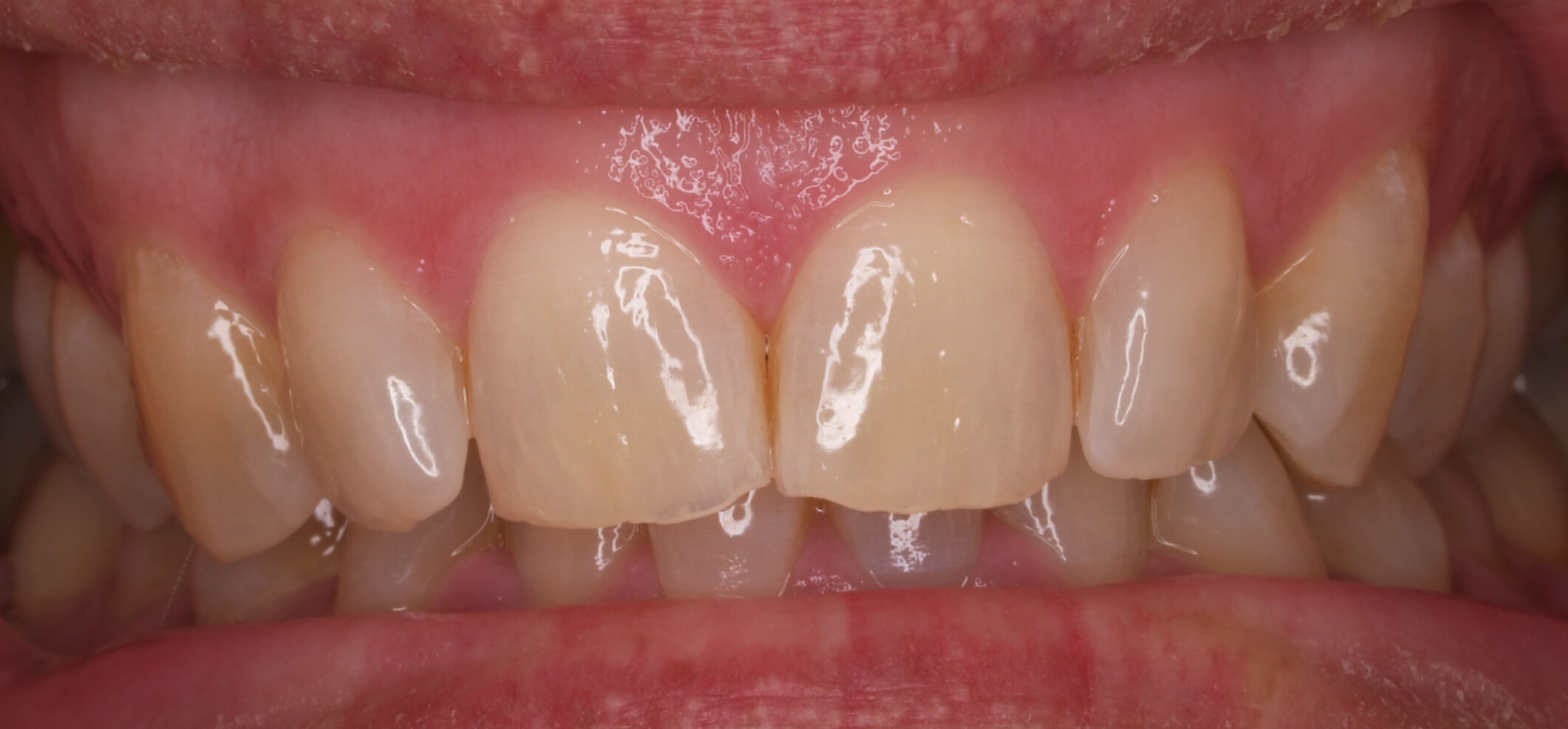 Caso clínico ANTES Blaqueamiento dental